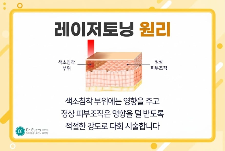 레이저토닝 효과 기미.잡티 - 닥터에버스 부평점 부평피부과